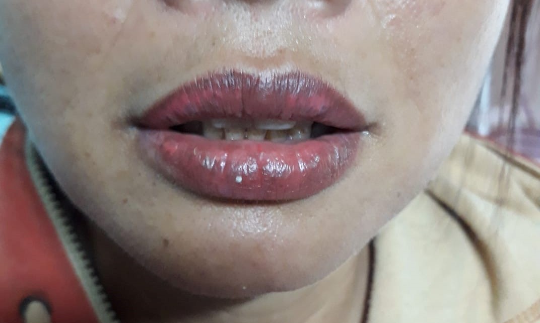 môi bị cháy tê 3